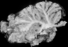 Organizing cerebellar necrosis, posterior inferior cerebellar artery circulation